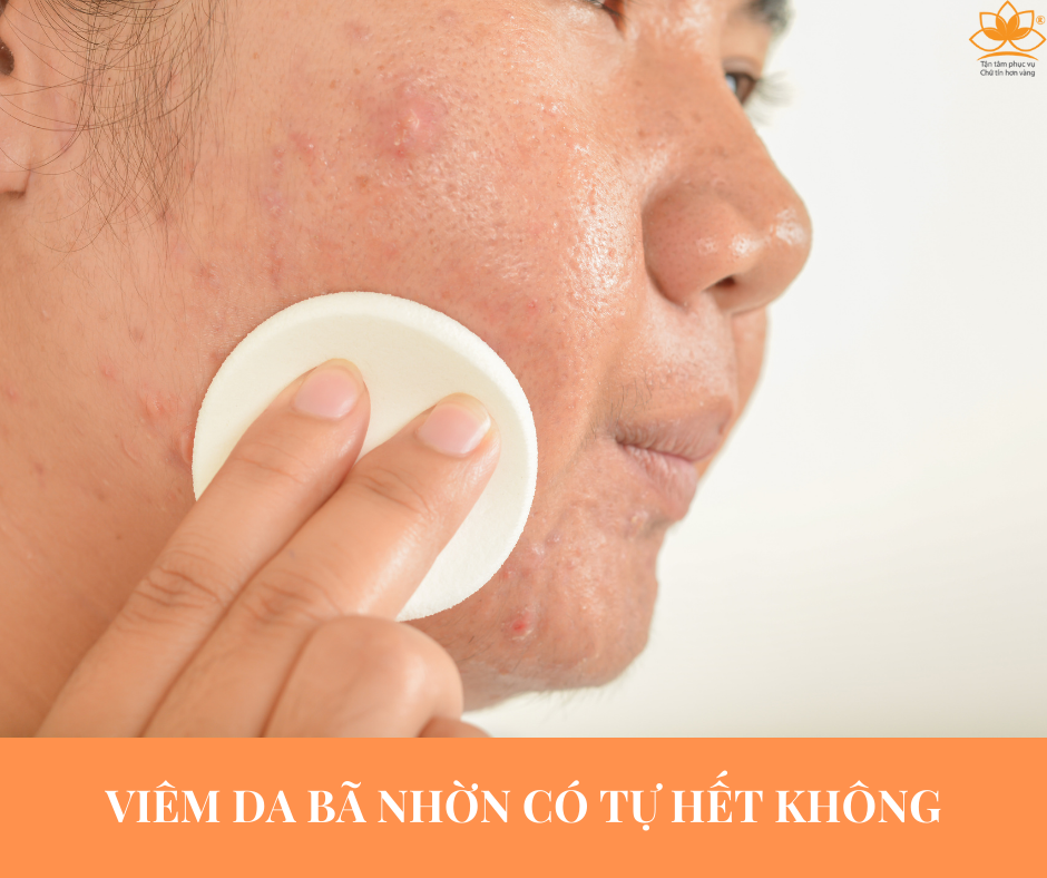 VIÊM DA BÃ NHỜN CÓ TỰ HẾT KHÔNG???